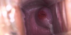 Cervix Snot
