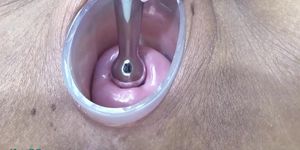 Japanese Wife Open Cervix Wide to watch inside Uterus