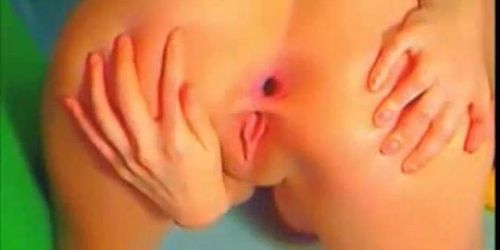 פִּקָה; נפער בתחת אנאלי מתיחה