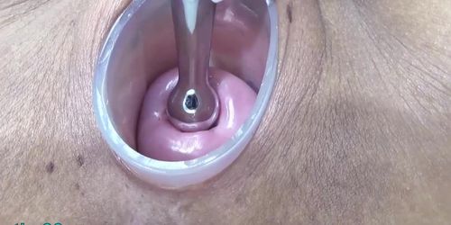 Japanese Wife Open Cervix Wide to watch inside Uterus