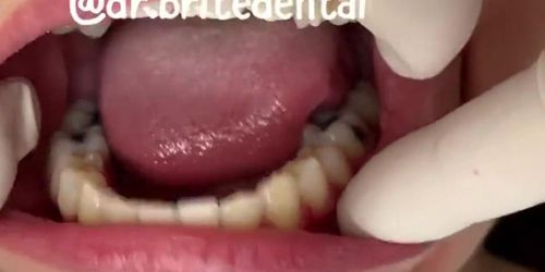 DENTIST SHOWS PERMANENT RETAINER