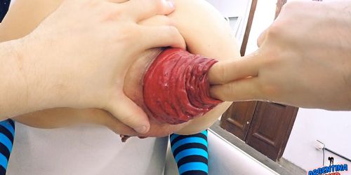 Most Extreme Anal Prolapse and Cervix Prolapse So Far. Fist.