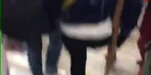 amputee one leg girl