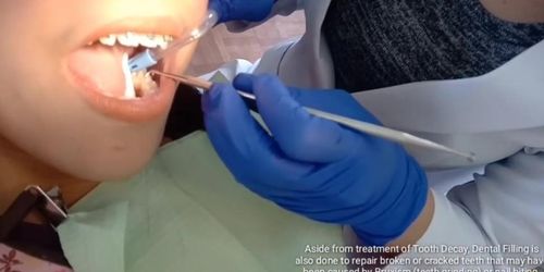 beauty with braces gets cavity filling