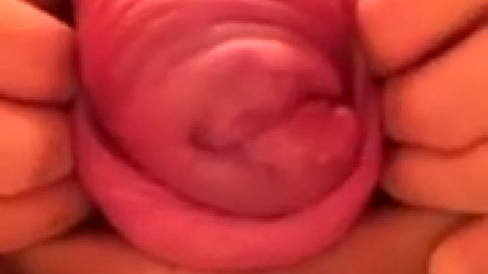 Prolapsed Cervix Porn Videos