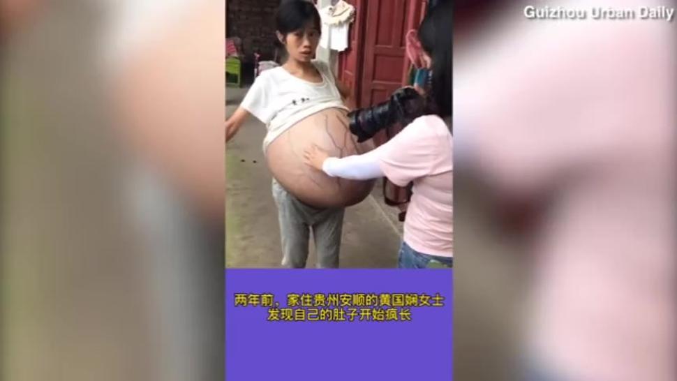 Chinese Woman has uncontrollably growing belly