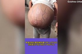 Chinese Woman has uncontrollably growing belly